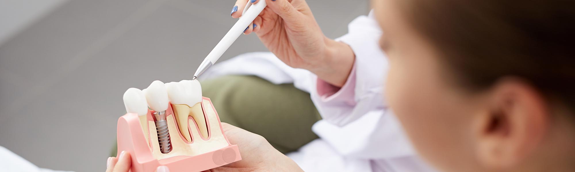 Dental Implants Benefits in Gardena CA