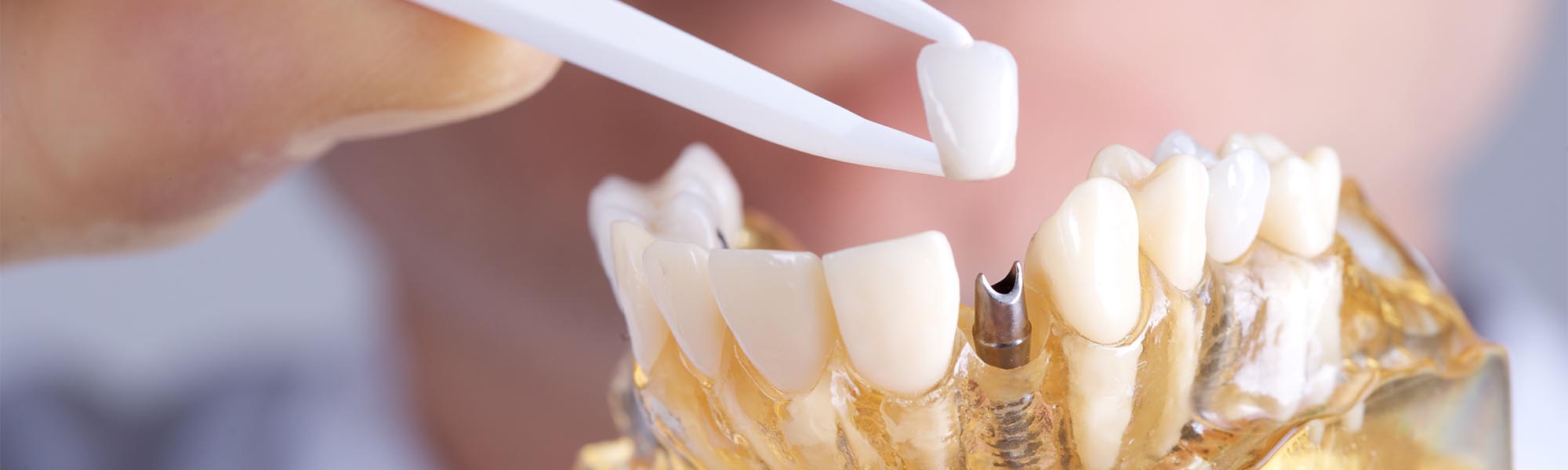 Multiple Teeth Implants Dentistry Gardena CA