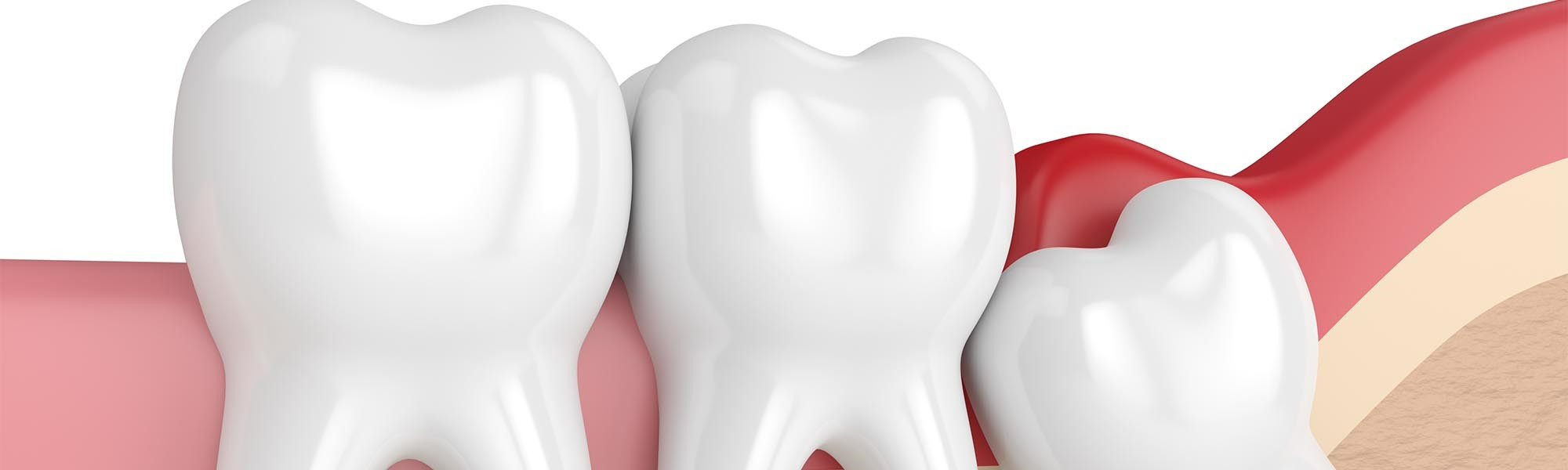 Wisdom Tooth Dentist Gardena CA