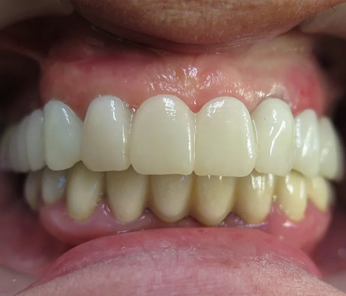 Dental Implants Gardena After
