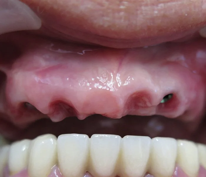 Dental Implants Gardena Before